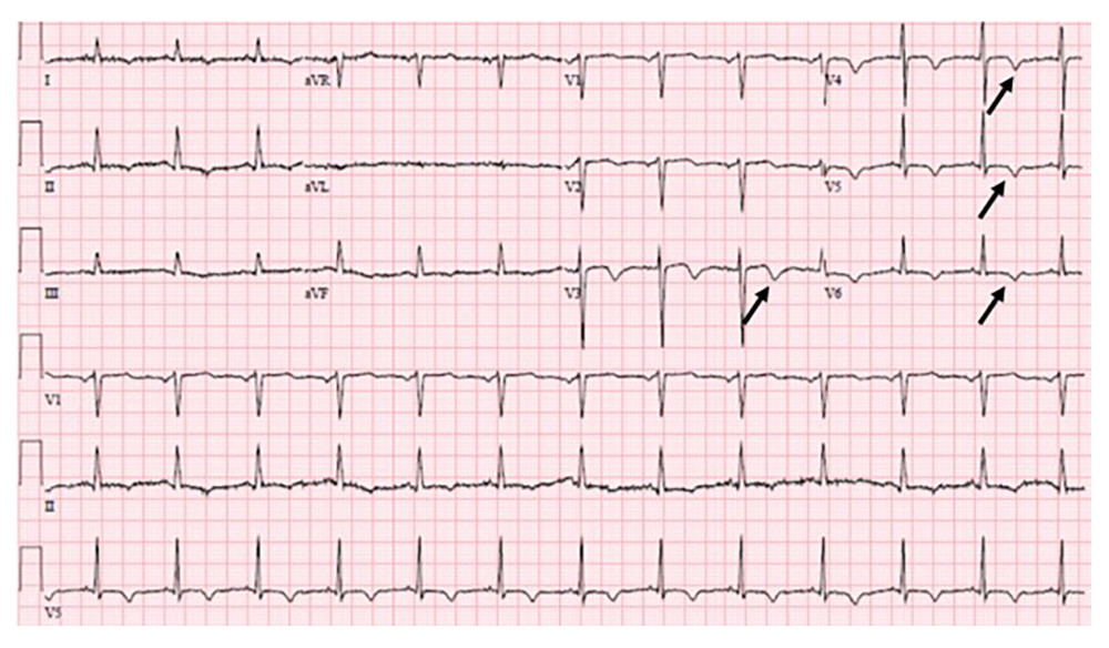 Electrocardiogram obtained on presentation. As shown by the rhythm strips, the patient had a normal sinus rhythm and normal rate. It is important to note the good R wave progression in the precordial leads as well as the normal amplitude of the QRS complexes. The dark black arrows in leads V3, V4, V5, and V6 represent the nonspecific T wave inversions that were visualized upon presentation.
