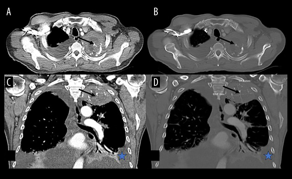 Axial and coronal views of the CT thorax with contrast obtained on presentation. Panel A shows the axial section of the thorax and visualization of the heterogeneous composition of the posterior left upper lobe mass while visualized in the abdominal window. Panel B shows the same image as panel A, but in the bone window. Panel C shows the CT thorax findings in the coronal view and abdominal window. Panel D shows the same image as panel C, but in the bone window. Thick black arrows in all panels point to the necrotic left apical mass. Blue stars in panels C and D indicate the left pleural effusion that was visualized. Additionally, a moderate pleural effusion was noted in the right lung field. CT – computed tomography.