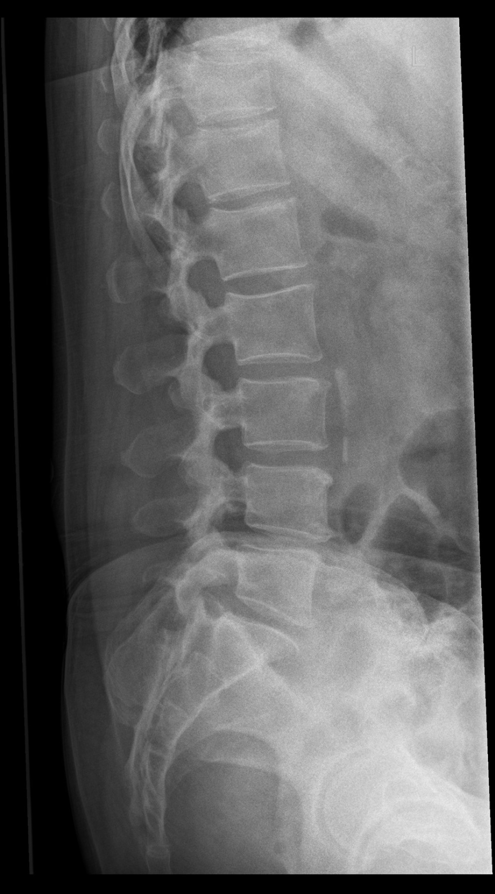 Initial lumbar spine radiograph showing known grade 1 anterolisthesis of L4-L5 and mild degenerative changes of the visualized lumbar spine.