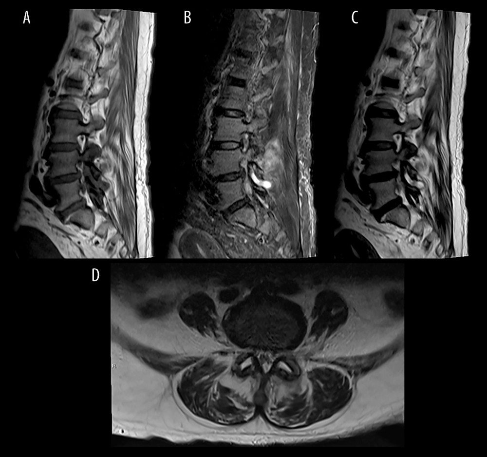 Unenhanced magnetic resonance images of the lumbar spine: (A) sagittal T2-weighted; (B) sagittal TIRM; (C) sagittal T1-weighted; and (D) axial T2-weighted. Facet joint hypertrophy with bilateral L4-L5 and L5-S1 facet joint effusions were seen, as well as mild patchy intramuscular edema in the posterior paravertebral muscles.
