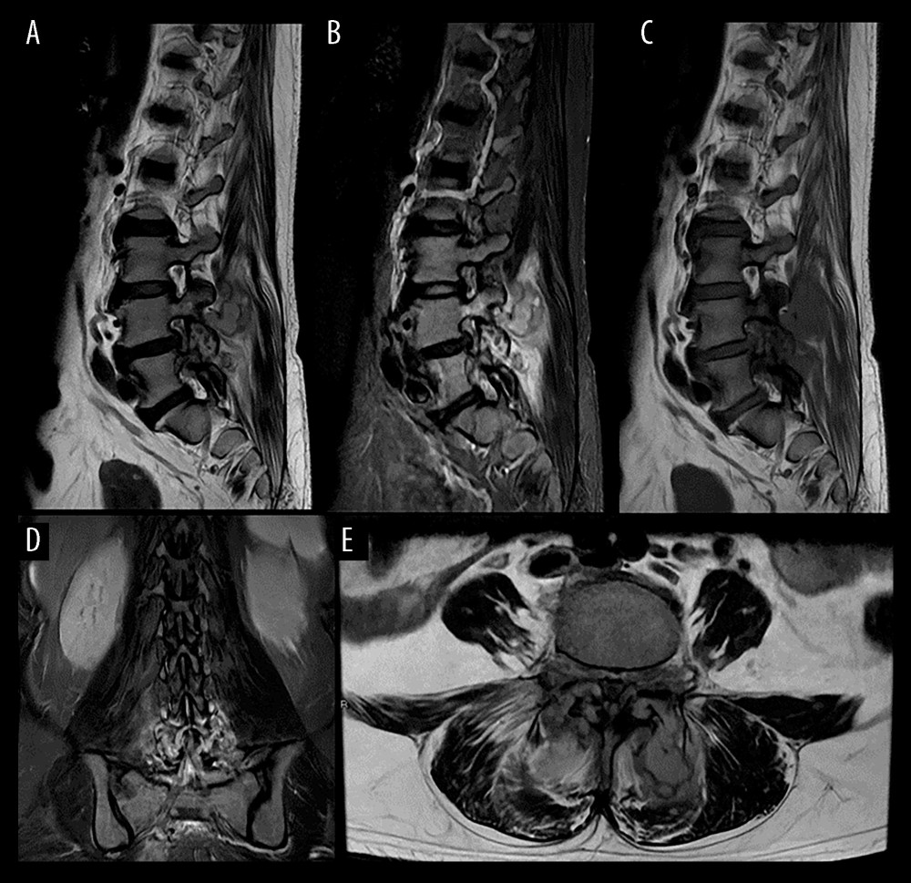 Unenhanced magnetic resonance images of the lumbar spine: (A) sagittal T2-weighted; (B) sagittal STIR; (C) sagittal T1-weighted; (D) coronal STIR; and (E) axial T2-weighted. Bilateral L4-L5 facet joint septic arthritis complicated with epidural and posterior paraspinal intramuscular abscesses.