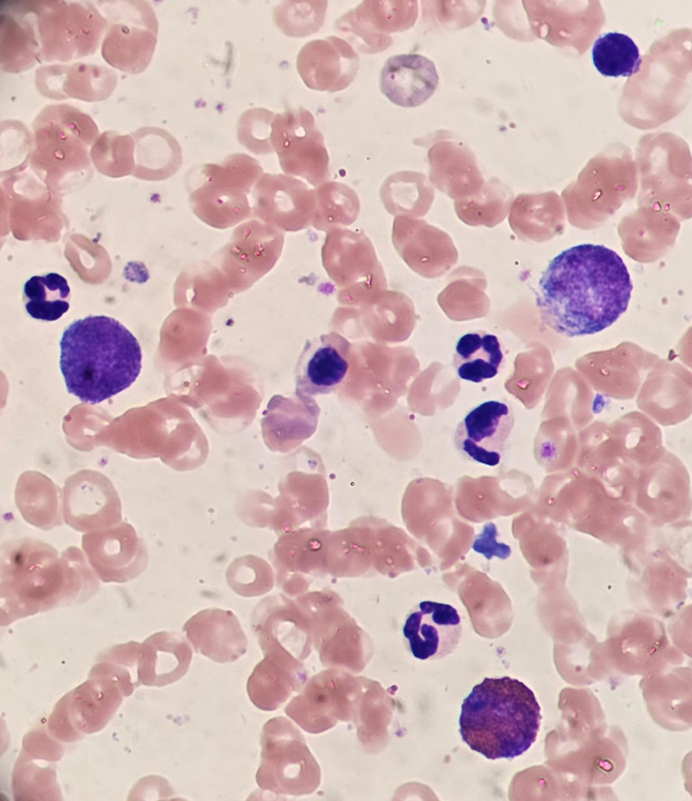 A bone marrow aspiration showing granulocytic hyperplasia with eosinophilia and basophilia (high power).