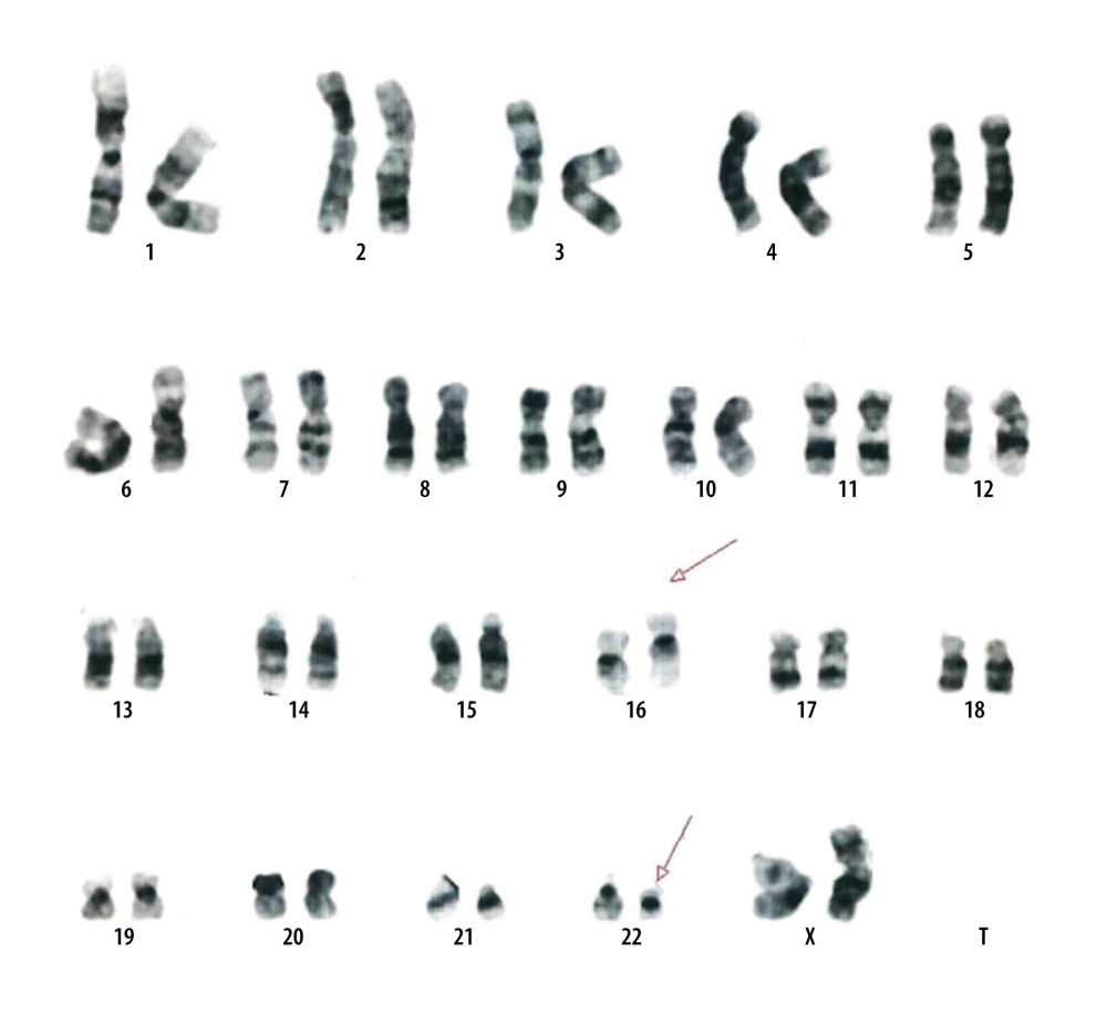 Karyotyping showing a female karyotype with translocation between the long arm of chromosome 16 at a break point q24 and chromosome 22 at a break point q11.2 (46, XX, t (16;22) (q24; q11.2) [20].