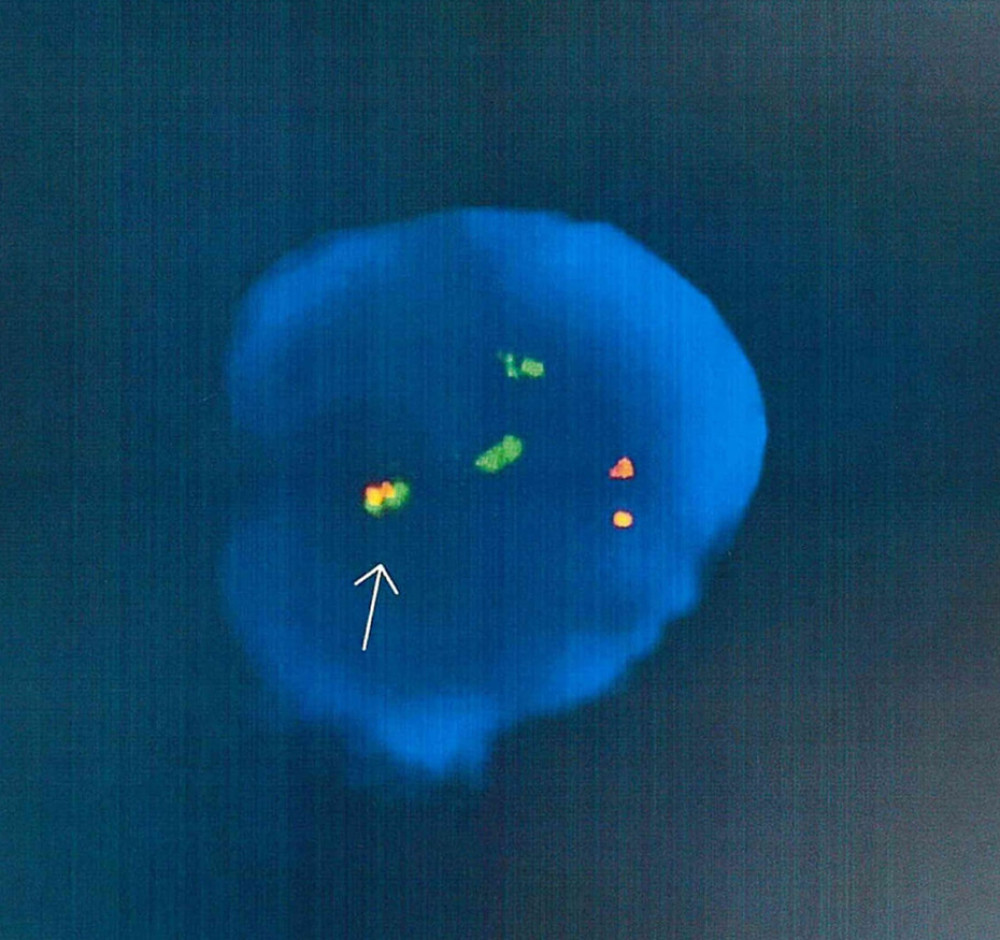 BCR-ABL fusion as a result of (9,22) translocation, with a third chromosome (chromosome 16) involved and fused with chromosome 22.
