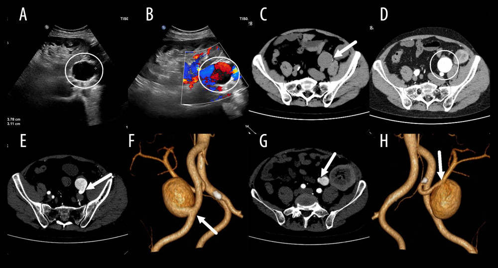 Preliminary ultrasound and computed tomography images. (A, B) Duplex ultrasound shows an oval-shaped hypoechoic structure (circle) adjacent to the left external iliac artery, with a swirling motion of blood flow inside (circle). (C, D) Computed tomography shows calcification in the aneurysm wall (arrow, C), without surrounding hematoma (circle, D). Computed tomography angiography 3D reconstruction and axial views shows an aneurysm of the left external iliac artery (arrow, E, F) communicating with the transplant renal artery (arrow, G, H).