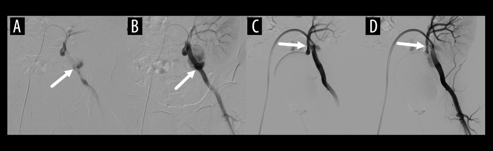 (A, B) Digital subtraction angiograms of left iliac artery show the aneurysm is supplied mainly by the left external iliac artery (arrow). (C, D) Digital subtraction angiograms after implantation of a covered stent graft in the left external iliac artery show contrast flowing into the aneurysm through the transplant renal artery (arrow).