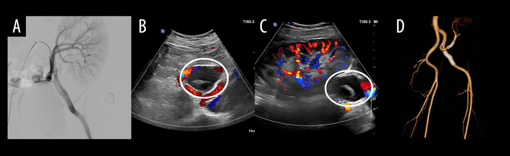 (A) Completed angiogram shows patent left external iliac artery and transplant renal artery, with no contrast flowing into the aneurysm. (B, C) Duplex ultrasound at 1month after the procedure shows the aneurysm was completely excluded, with no blood flow within (circle). (D) Computed tomography angiography 3D reconstructions at 4 months after the procedure show patent left external iliac artery and transplant renal artery, with no contrast flowing into the aneurysm.
