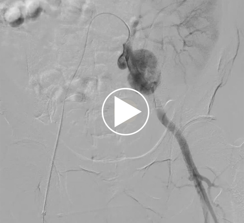 Digital subtraction angiograms of left iliac artery show contrast flows into the aneurysm through the left external iliac artery (00: 00: 01″), and fulfill the aneurysm body (00: 00: 03″-00: 00: 06″).