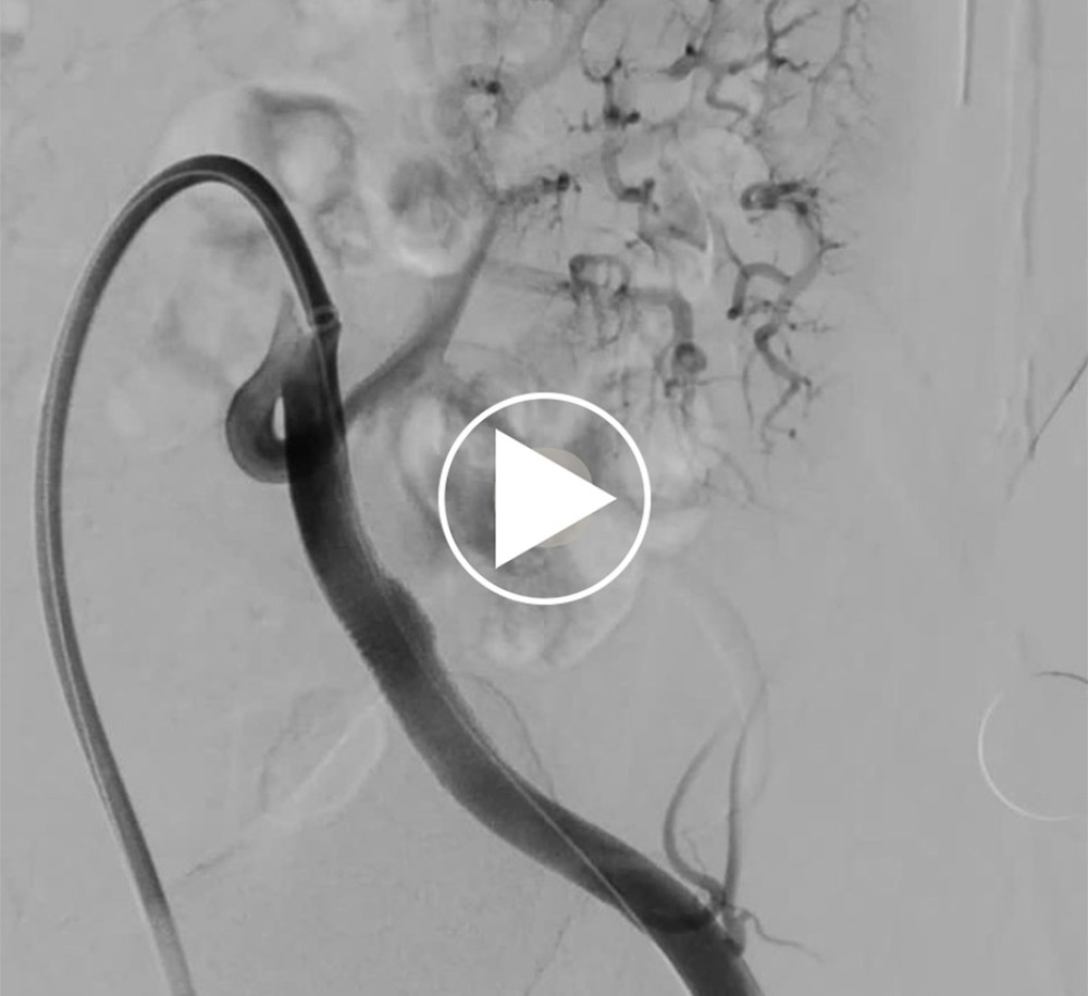 Digital subtraction angiograms after implantation of a covered stent graft in the left external iliac artery show contrast flows into the aneurysm through the transplant renal artery (00: 00: 02″), and fulfill the aneurysm body (00: 00: 03″-00: 00: 04″).