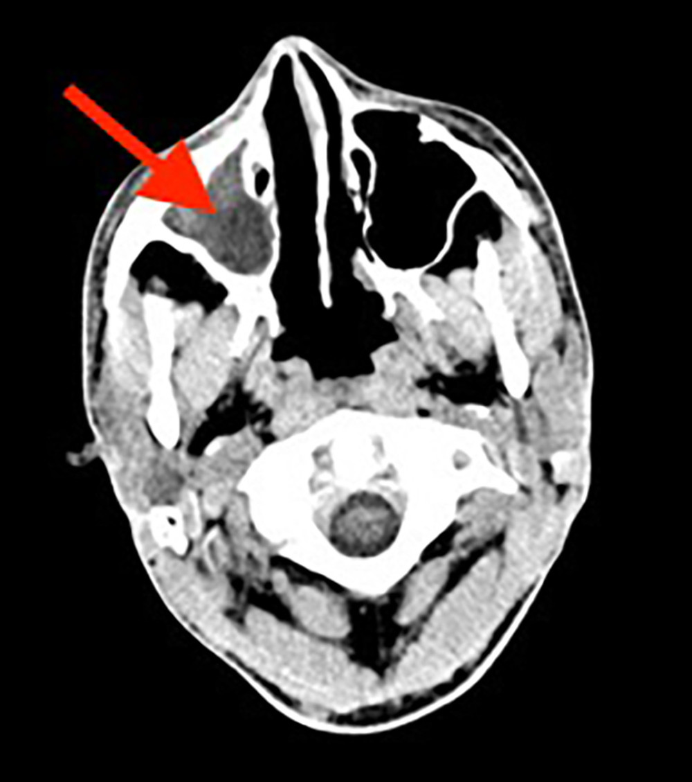 Computed tomography (CT) scan of the head revealed complete opacification of the right maxillary sinus characteristic of right maxillary sinusitis (red arrow).