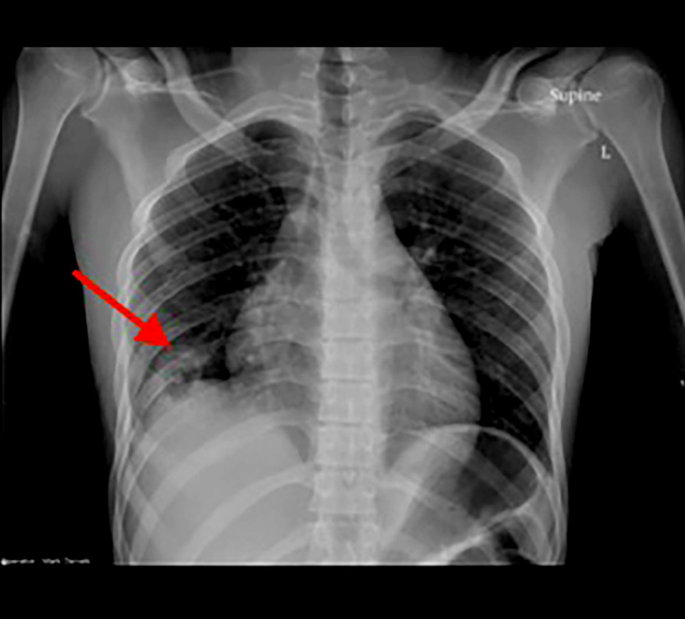Chest X-ray (CXR) revealed a thick-walled cavitary lesion in the right lower lobe of the lung (red arrow).