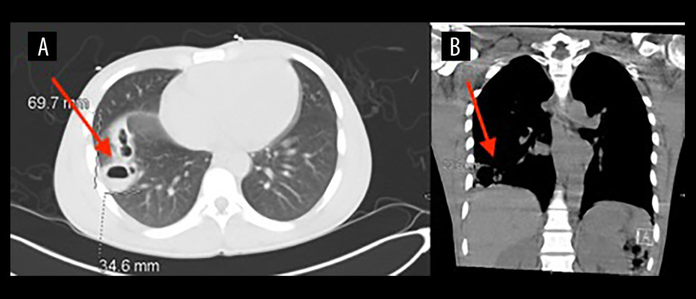 Axial (A) and coronal (B) computed tomography (CT) scans of the chest revealed a 7×3.5×3 cm cavitating lesion in the right lower lobe of the lung (red arrows).