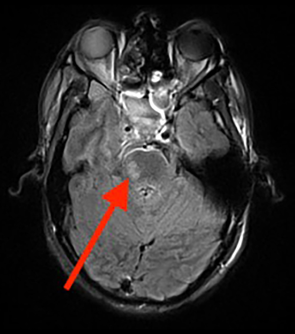 Magnetic resonance imaging (MRI) scan of the brain demonstrated a 1.8×0.7 cm area of increased T2 signal in the right pons, consistent with an acute infarct (red arrow).