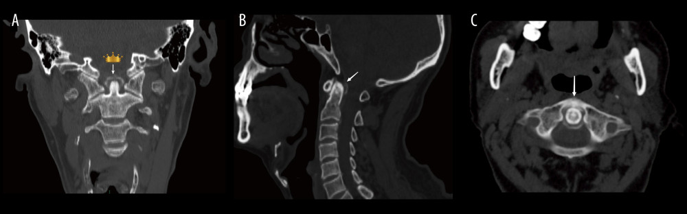 Coronal, sagittal, and axial computed tomography (CT) scan. (A) Coronal CT scan of the cervical spine indicating calcifications up the dens (crown-like icon and white arrow). (B) Sagittal CT scan of the cervical spine indicating calcification behind the dens (white arrow). (C) Axial CT scan of the cervical spine indicating calcifications surrounding the dens (white arrow).