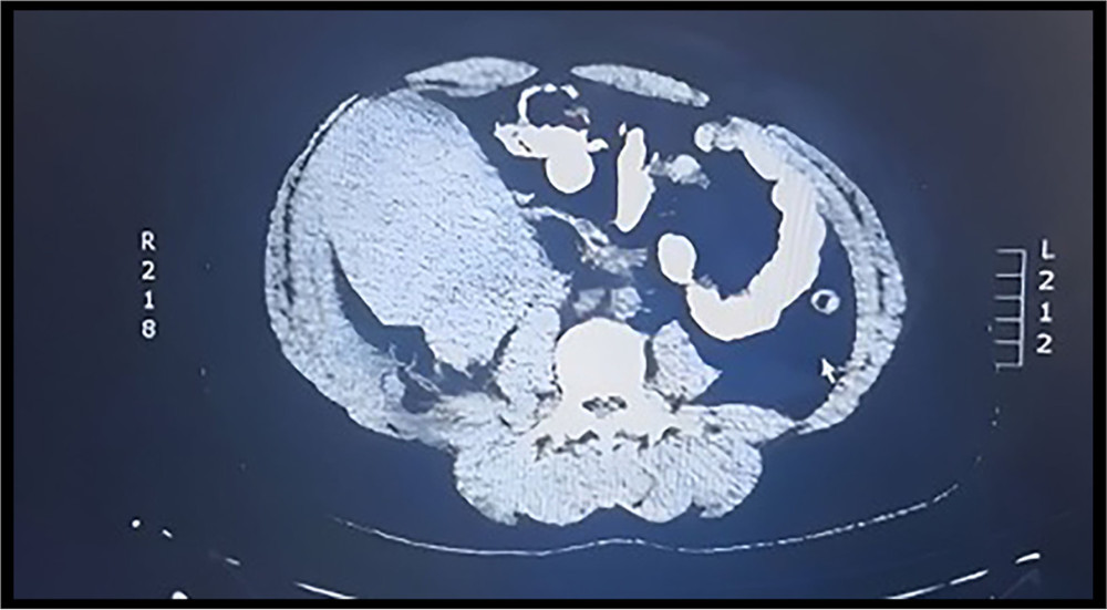 Computed tomography of the abdomen and pelvis with intravenous contrast showing a right-sided abdominal, retroperitoneal, well defined, isodense, non-enhancing mass lesion measuring 8.5×13×15 cm displacing the cecum and the right kidney medially. Patient refused oral contrast, due to abdominal pain.