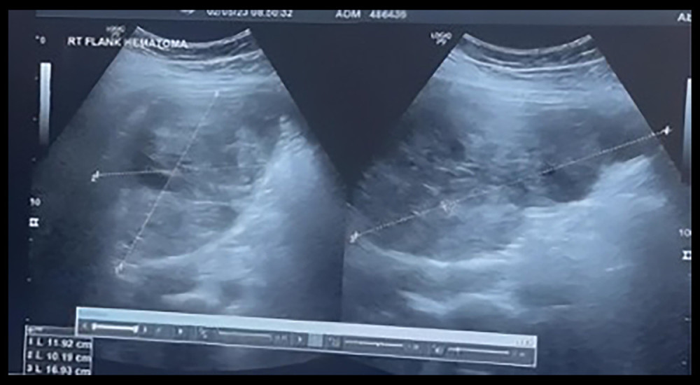 Ultrasound of the abdomen showing a right-sided retroperitoneal hematoma displacing the right kidney medially and measuring 12×10×12 cm.