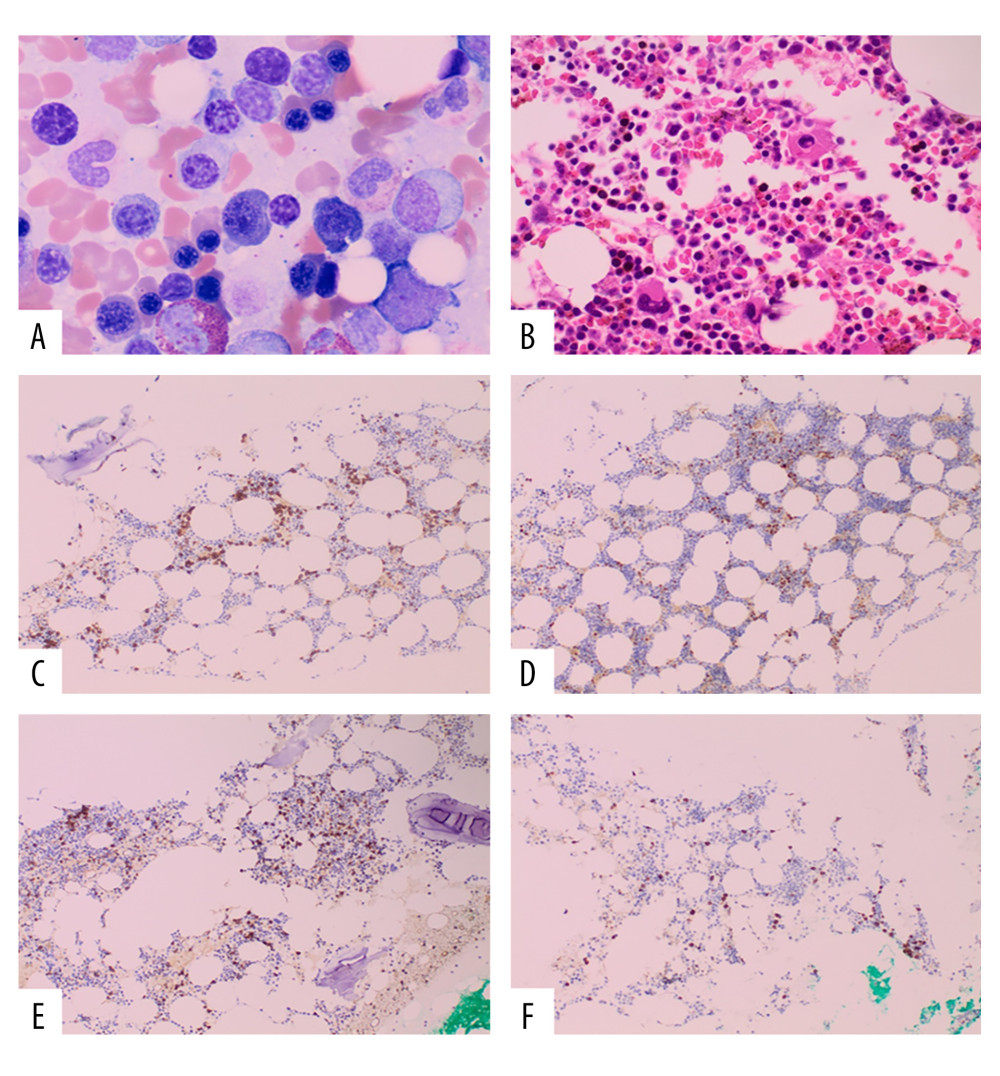 Sections show bone marrow aspirate and biopsy with increased plasma cells (A, Wright Giemsa, 100×; B, H&E, 10×). These plasma cells account for 10–15% of marrow cellularity (C, IHC, CD138 stain, 10×) and also aberrantly express cyclin D1 (D, IHC, 10×). Increased CD20+ B cells with a few ill-defined clusters (E, IHC, 10×) and rare scattered CD3+ T cells (F, IHC, 10×). H&E – hematoxylin and eosin; IHC – immunohistochemistry.