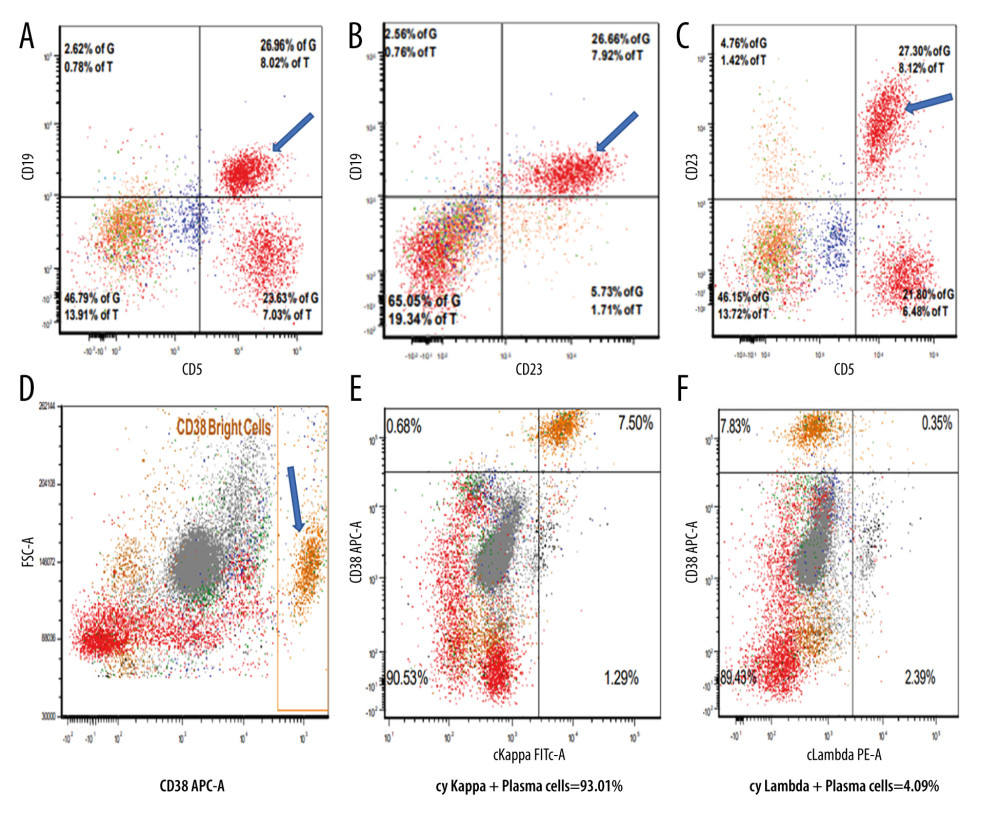 Flow cytometry analysis of bone marrow aspirate shows CLL. CD5+/CD19+ B lymphocytes (upper outer quadrant, 8.02%, blue arrow) (A). CD19+ B lymphocytes aberrantly expressing CD23 (upper outer quadrant, 7.92%, blue arrow) (B). CD5+ B cells with aberrant expression of CD23 (upper outer quadrant, 8.12%, blue arrow) (C). In (A), lower outer quadrant shows CD5+/CD19- T cells. There is a separate population of CD38+ bright plasma cells plotted against forward scatter (blue arrow, 8.03%) (D). This population of plasma cells shows kappa light chain restriction (E, F).