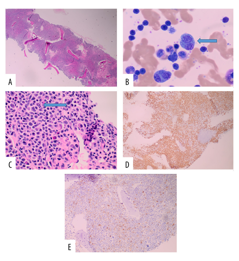 Bone marrow section with 100% cellularity (A H&E, 10×) and increased plasma cells, some of which show Mott cells and Dutcher bodies [arrowed in B and C, respectively. Images taken at 100× (Giemsa) and 20× (H&E) respectively]. The increased plasma cell infiltrates are highlighted with CD138, comprising 70–80% of marrow cellularity (D, IHC, 20×). Some of the plasma cells express CD117 (E, IHC, 20×). H&E – hematoxylin and eosin; IHC – immunohistochemistry.