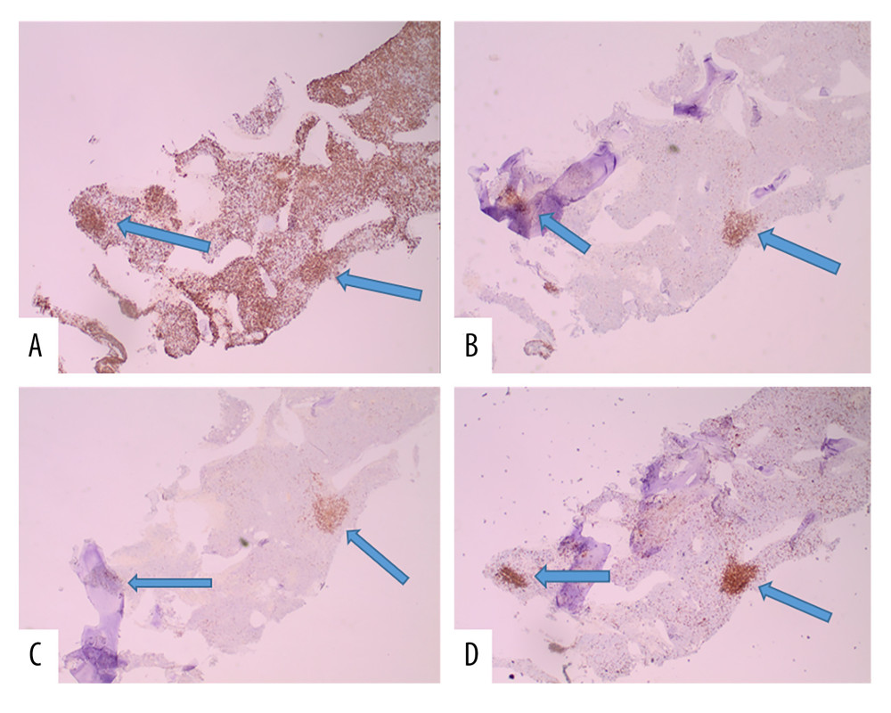 A separate population of clustered B cells (blue arrows) that express CD20 (A, IHC, 10×), CD 79a (B, IHC, 10×), PAX5 (C, IHC, 10×), and CD5 (D, IHC, 10×) are also seen within the bone marrow. In Figure 4A, sheets of neoplastic plasma cells in the background aberrantly express CD20. IHC – immunohistochemistry.