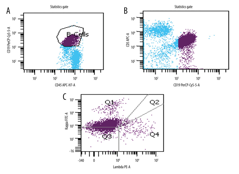 Flow cytometry of bone marrow aspirate showing a population of kappa-restricted CD19 dim+ B cells with aberrant expression of CD5 (A, B). The population of B cells are kappa-restricted (C).