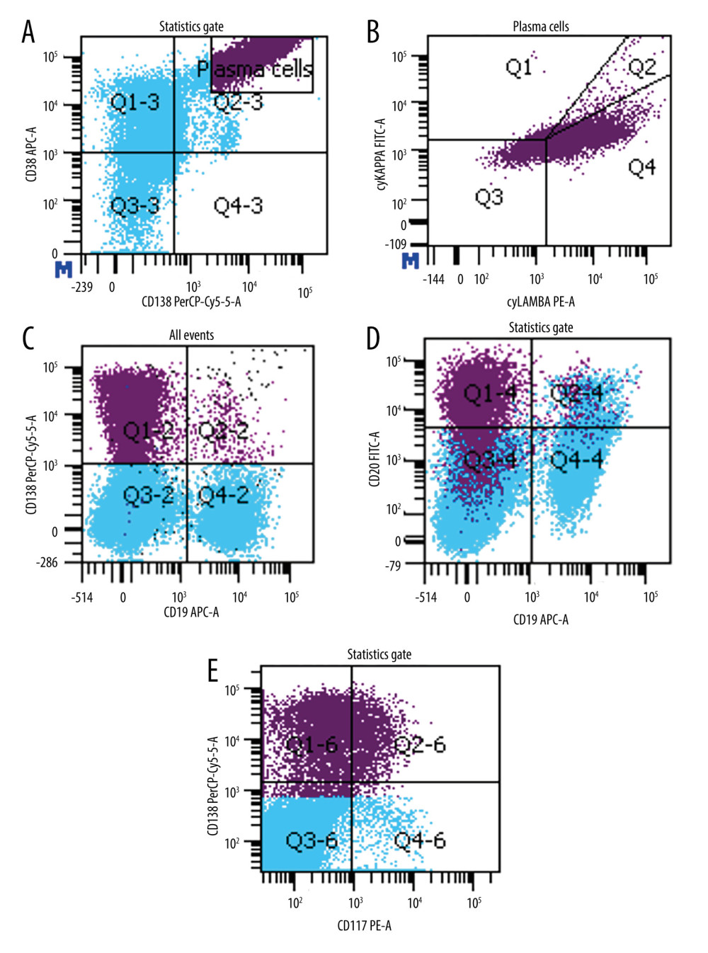 Flow cytometry of bone marrow aspirate showing a population of lambda-restricted neoplastic plasma cells (CD38+++/CD138+) (A, B) with loss of CD19 and aberrant expression of CD20 (C, D) and partial CD117 expression (E).