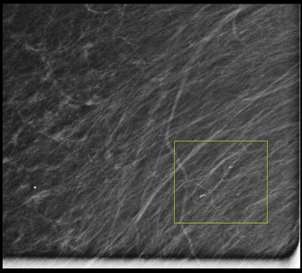 Right breast diagnostic mammogram exhibiting a focal area of indeterminate calcifications in the posterior outer right breast.