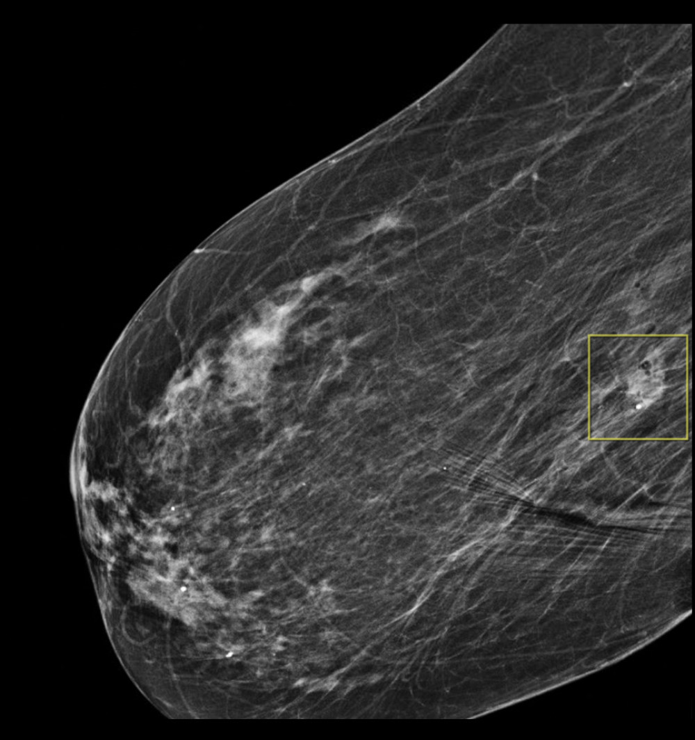 Post-stereotactic right breast biopsy mammogram demonstrating the sampled region of indeterminate calcifications, with a marker clip at the biopsy site in a satisfactory position.