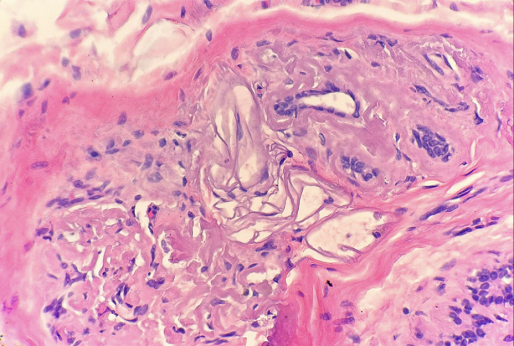 Microscopic examination reveals extracellular deposition of acellular eosinophilic material in fat, stoma, and blood vessels (staining with hematoxylin and eosin, 40× magnification).