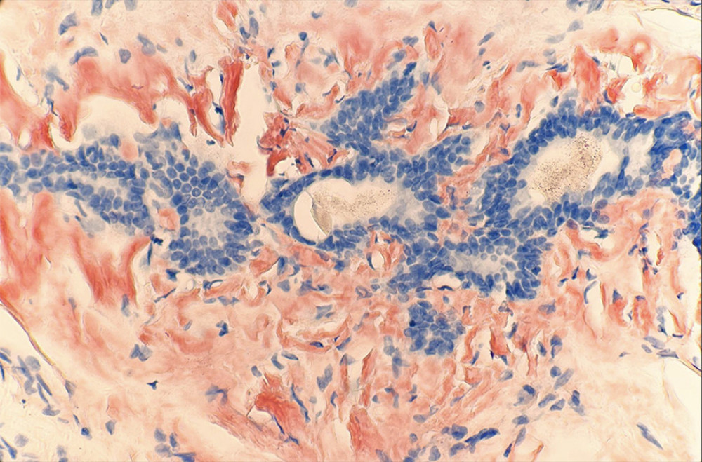 Congo red special stain is positive (40× magnification).