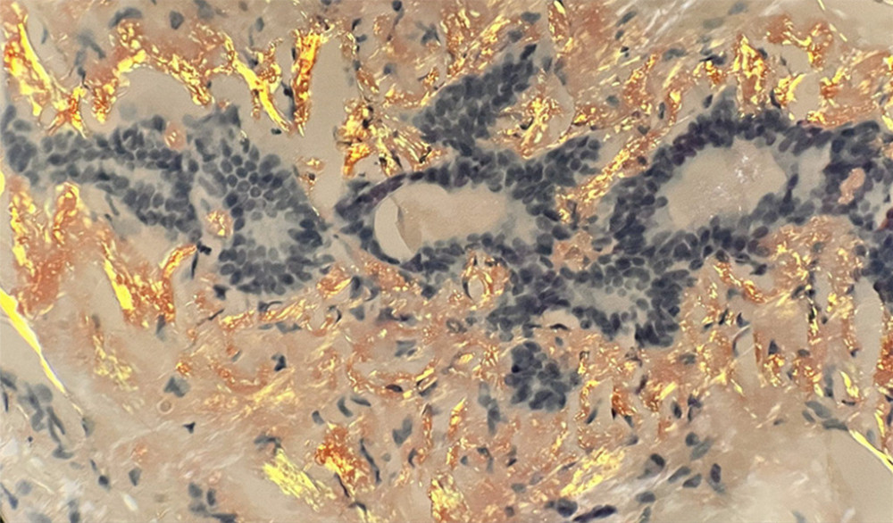 Amyloid proteins with Congo red special stain show apple green birefringence under polarized light (40× magnification).