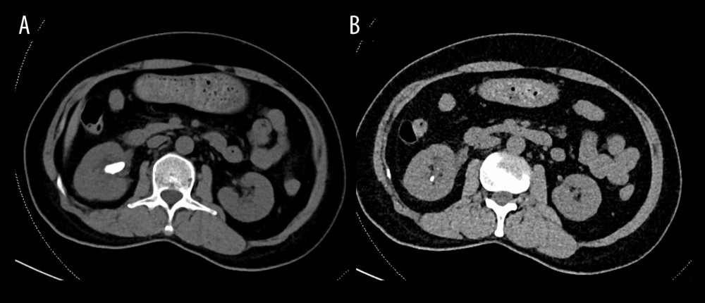 Preoperative computed tomography urology revealing multiple right renal stones with maximum diameter measuring 20×9 mm (A) and 1 located at the lower calyx (B).