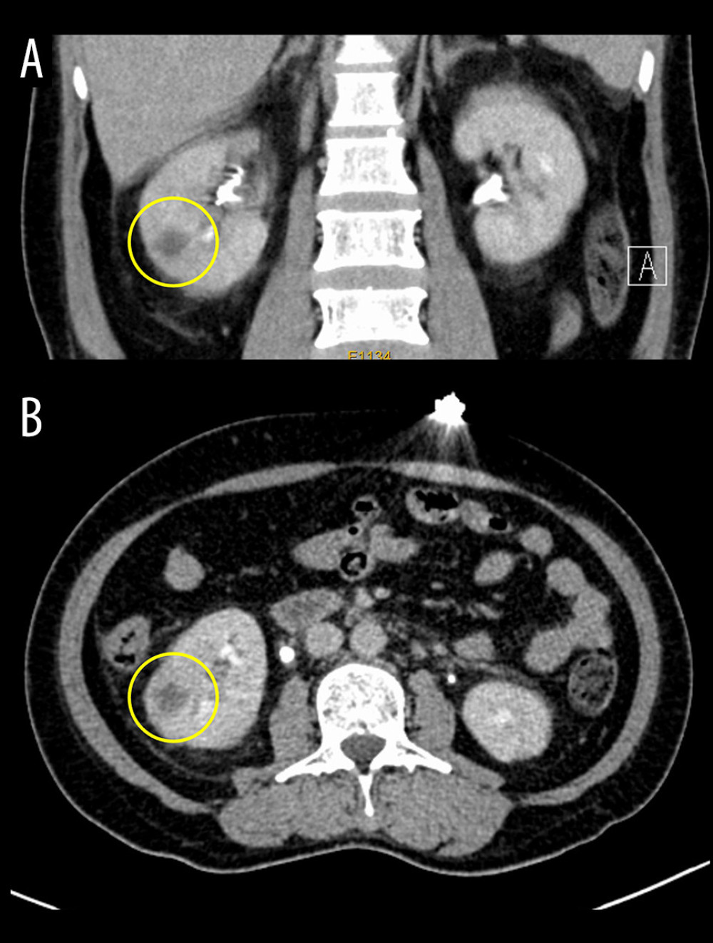 Follow-up computed tomography urology showing the postoperative right renal abscess (yellow circle) of the female patient at coronal plane (A) and axial plane (B).