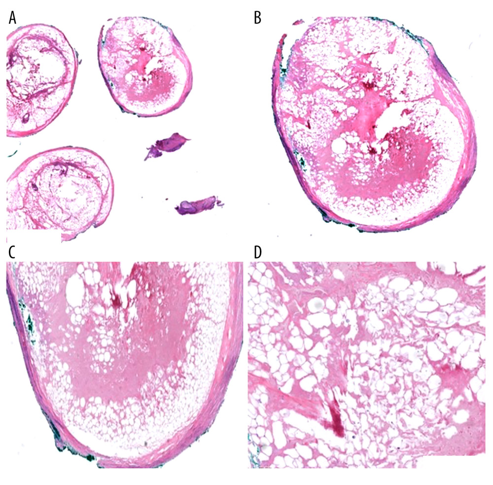 Histologic sections of the colonic epiploica. Microscopic examination shows well-circumscribed adipose tissue with fibrotic wall (A, B) demonstrating fat necrosis (C, D). Hematoxylin and eosin, magnification in (A) 2×, (B) 4×, (C) 10×, (D) 20×.