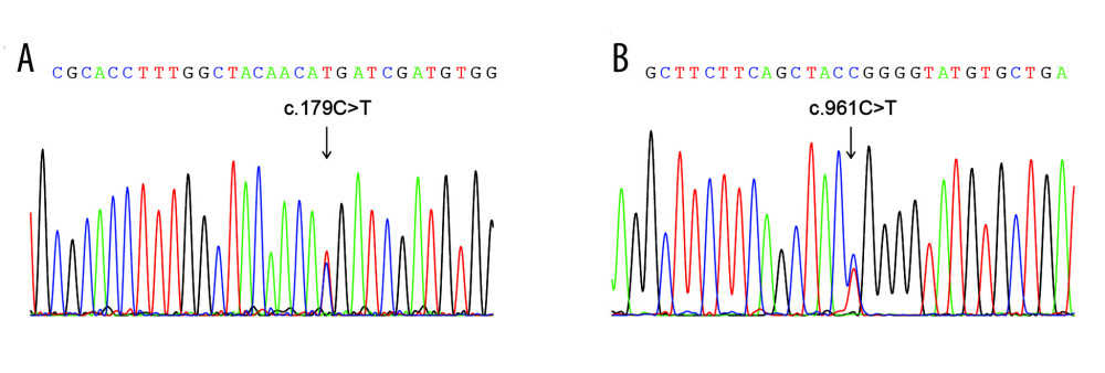 Next-generation sequencing analysis detected a compound heterozygous mutation in the SLC12A3 gene. The mutation was validated using Sanger assay, with c.179C>T in exon 1 (A) and c.961C>T in exon 7 (B) of the SLC12A3 gene.