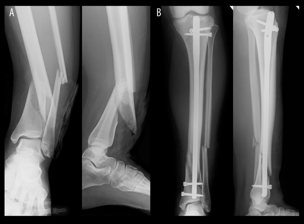 (A) Radiographs of anteroposterior view and lateral view at the time of injury. Open fractures of the left tibia and fibula were observed. (B) Radiographs after osteosynthesis using an intramedullary nail on the day of the injury.