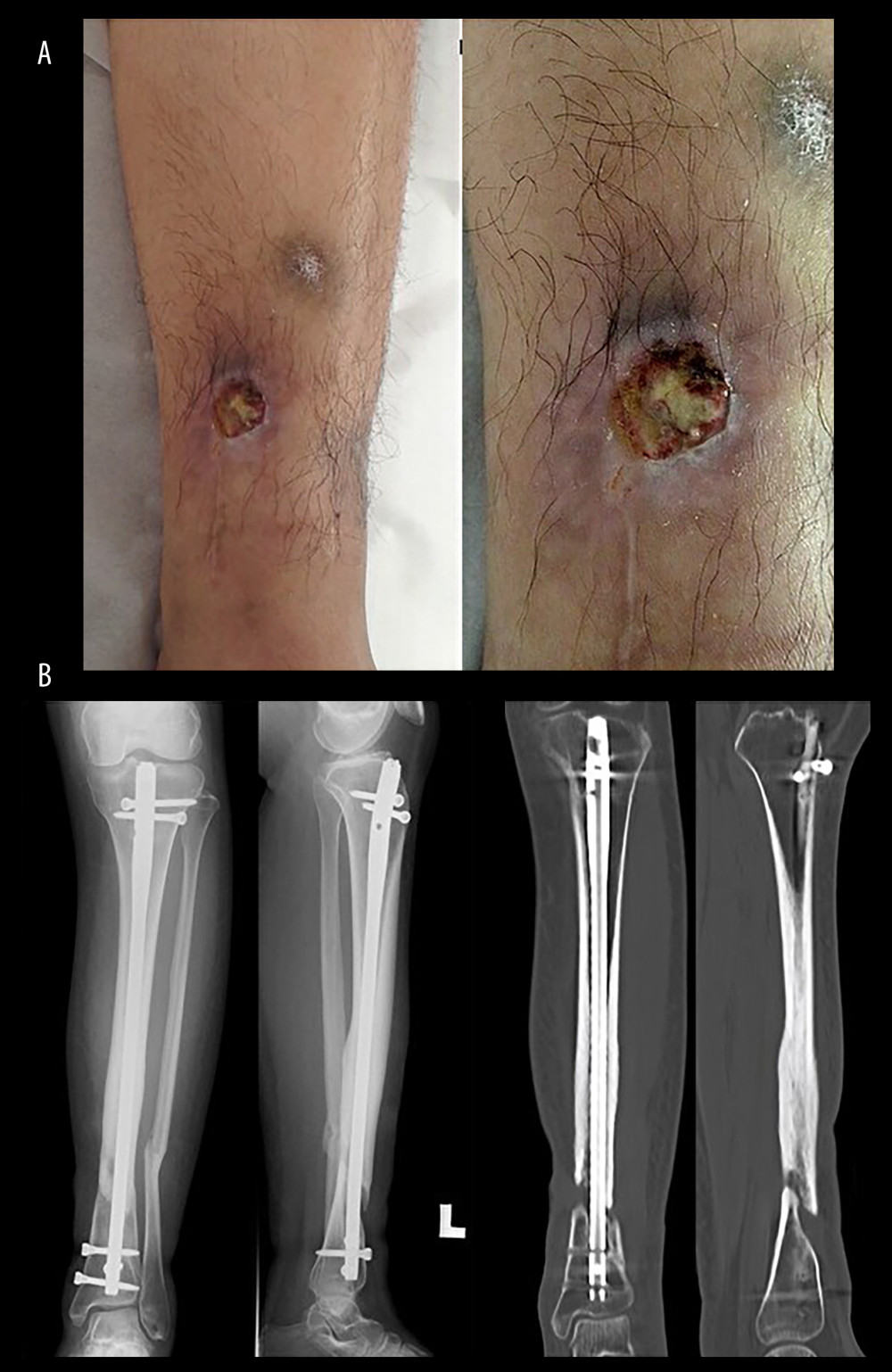 (A) Photographs 15 months after osteosynthesis using an intramedullary nail. The patient began exhibiting skin defects and draining of pus proximal to the wound. (B) Radiographs and computed tomography scans 27 months after the first surgery. The fracture was not united, and bone defects were observed at the anterior and medial parts of the fracture site.