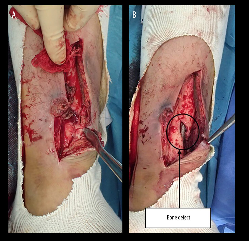 Photographs taken during surgery. (A) The fistula communicated with the bone defect through the subcutaneous pocket, with pus and infectious tissue filling the bone defect. (B) The bone defect measured 2.5×1 cm, mainly in the anterior and medial aspects of the distal tibia.
