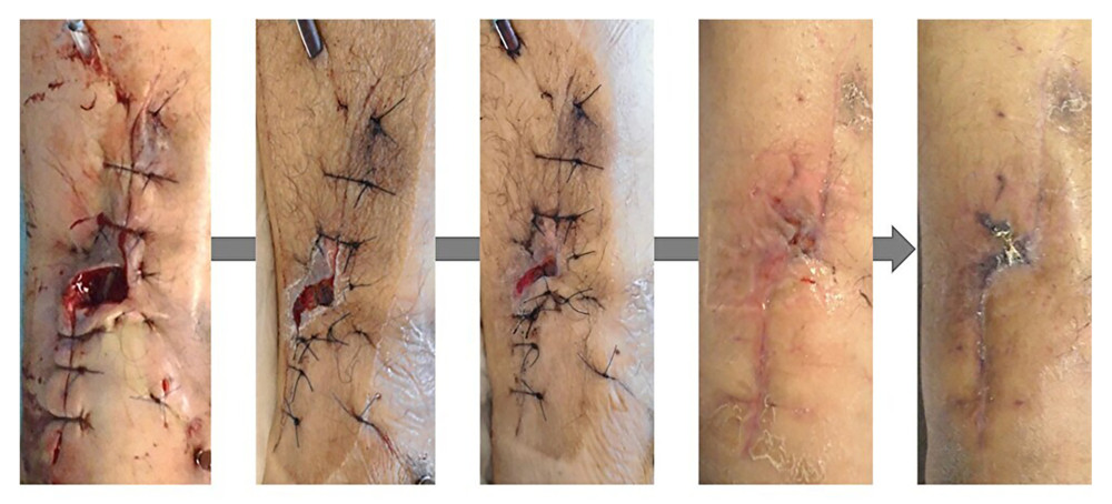 Photographs of skin-defect area. Negative pressure wound therapy was applied over the subcutaneous pocket and skin defect. Skin defects gradually reduced as swelling decreased, finally healing without additional surgery 1 month after the continuous local antibiotic perfusion surgery.