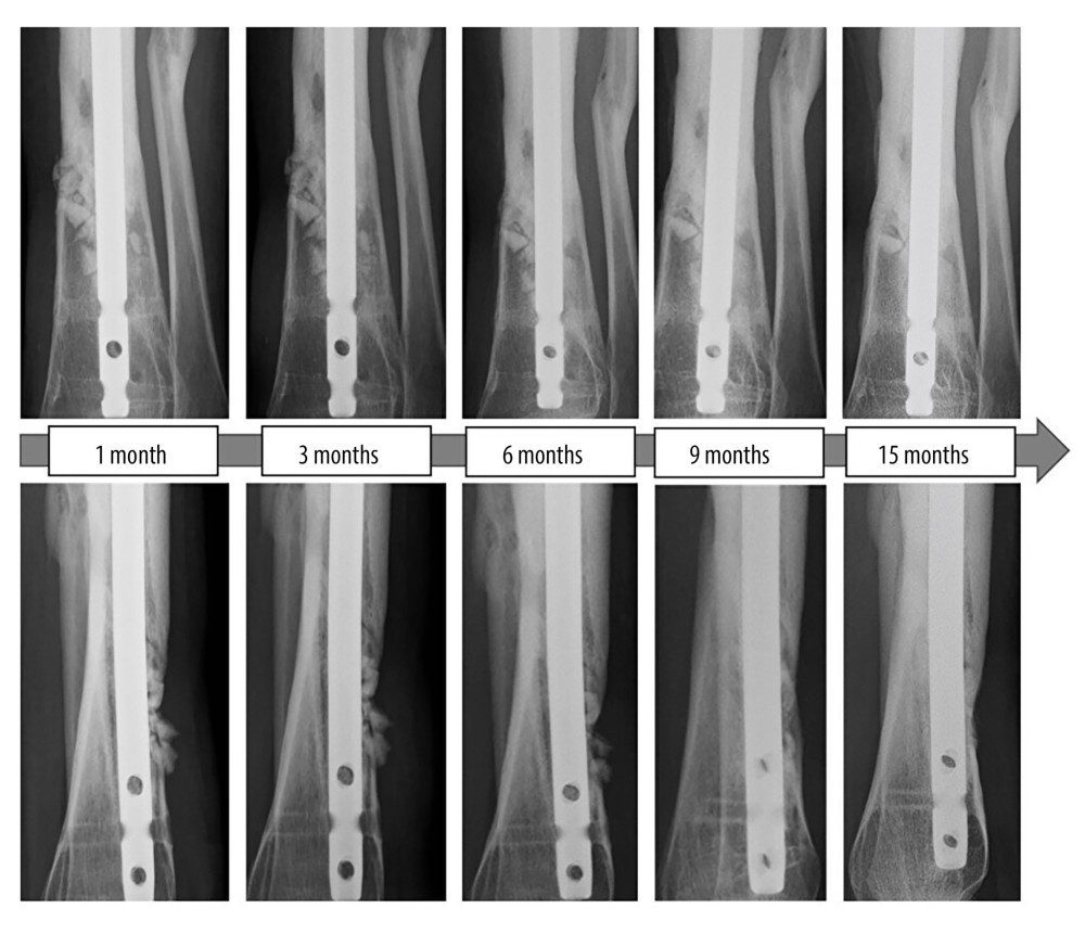 Radiographs of the nonunion site until 15 months after surgery (Above: anteroposterior view, Below: lateral view). Bone remodeling continued to progress at the β-TCP transplant site, and cortical bone bridging and new bone formation in the medullary cavity were observed 15 months after continuous local antibiotic perfusion surgery.