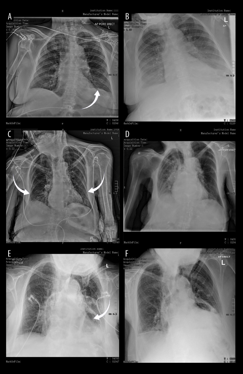 Chest X-ray findings at presentation and after admission. (A) Case 1: Chest X-ray at presentation showed atelectasis (loss of volume) at left lung base resulting in an elevated left hemidiaphragm (arrow). (B) Case 1: An episode of desaturation on day 6 after admission was associated with radiographic evidence of acute pulmonary edema. (C) Case 2: Chest X-ray at presentation showed atelectasis affecting both lungs (arrows). (D) Case 2: Two days after admission, chest X-ray showed a small right pleural effusion, consolidation in the right middle and lower zones, and a new infiltrate at the left base. (E) Case 3: Chest X-ray at presentation showed bibasilar atelectasis and a large intrathoracic hernia (arrow). (F) Case 3: Five days after admission, the patient’s chest X-ray result was unchanged.