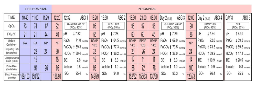 Case 3. Ambulance (pre-hospital) observations and selected hospital observations and blood gas analyses. ABG on arrival in the ED showed type II respiratory failure (ABG1). In the absence of an identifiable risk factor for oxygen-induced CO2 retention, the SpO2 target range was set at 94–98% and the patient was started on BPAP. On oxygen 5 L/min via nasal prongs (approximate FiO2: 40%), the SpO2 was below the target range (92%). Elevation of the FiO2 to 55% on BPAP was associated with a paradoxical worsening of hypoxia and a marked rise in the PaCO2 (ABG2). In response to this, the FiO2 was further increased to 60% overnight. This was associated with a decline in GCS to 11–15. Blood gas analysis was not performed at that time. Significant hypercapnia persisted following resolution of the acute event in association with a worsening metabolic alkalosis (ABG5). Airway pressures (cmH20) delivered on BPAP and CPAP are in parentheses. RA – room air; NHF – nasal high flow; BE – base excess. Reference ranges: ABG, pH (7.35–7.45), PaCO2 (35–45 mmHg), PaO2 (70–100 mmHg), HCO3– (21.0–28.0 mmol/l), BE (−2 to 3 mEq/l), Lactate (0.4–0.8 mmol/l). VBG, pH (7.35–7.45), HCO3–, Lactate, PCO2, PO2, BE and SO2 measured on a VBG have no defined reference range.