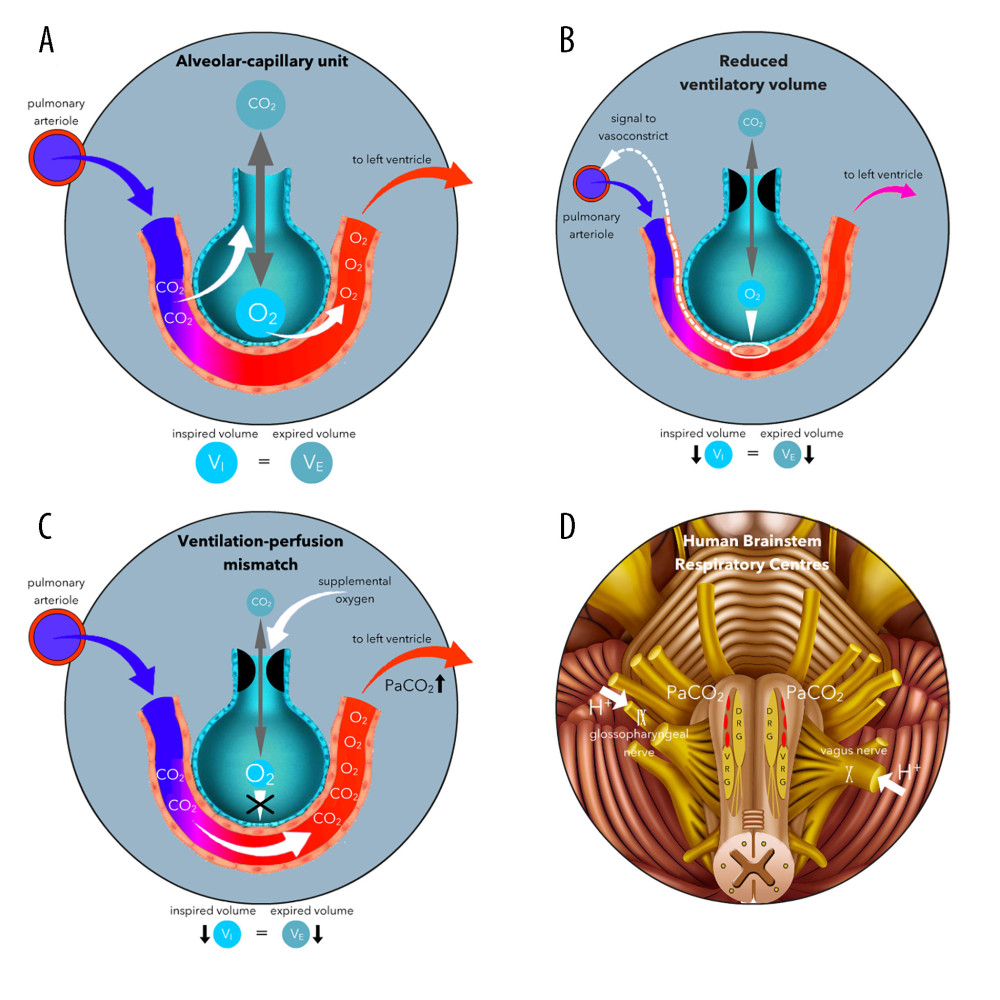 The mechanism underlying loss of hypoxic pulmonary vasoconstriction (HPV) during inhaled oxygen therapy. The mechanism depends on elevation of the PAO2 independent of any change in the PaO2. (A) Elimination of CO2 taken up from the alveolar capillaries and maintenance of the PAO2, depends on an adequate volume of air entering and leaving the alveoli per unit time (grey arrow). (B) Reduced regional alveolar ventilation results in reduced elimination of CO2 and a fall in the PAO2. The fall in PAO2 is sensed by the alveolar capillary endothelium (white circle) and regional arterioles are signalled to constrict. (C) Supplemental oxygen raises the PAO2 and HPV is lost. An increased volume of blood with high CO2 content reaches alveoli incapable of excreting the gas and the PaCO2 rises. (D) Elevated PaCO2 is sensed by brainstem respiratory centers, which increase global pulmonary ventilation. In a normal young individual, the excess CO2 is eliminated and the rise in PaCO2 is transient. DRG – dorsal respiratory group; VRG – ventral respiratory group.