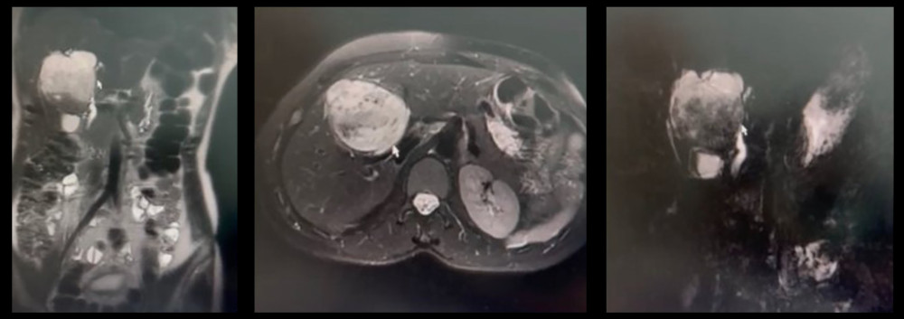 Magnetic resonance cholangiopancreatography (MRCP) image including coronal and axial sections and MRCP view. MRCP shows complicated cystic lesion (yellow arrow) that compressed common hepatic duct bifurcation (red arrow) and proximal parts of both the right (not shown) and left (green arrow) proximal hepatic ducts.
