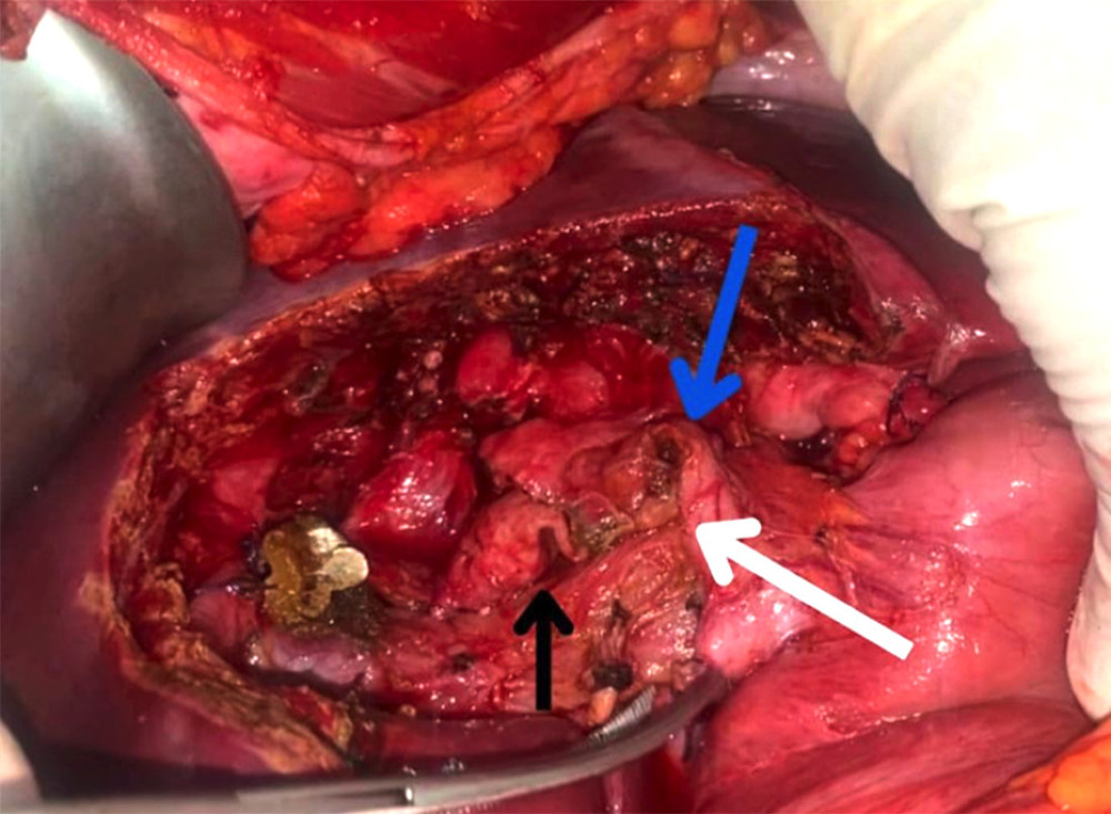Intraoperative picture after central liver resection, showing left hepatic duct (black arrow), right hepatic duct (blue arrow), and common hepatic duct (white arrow).