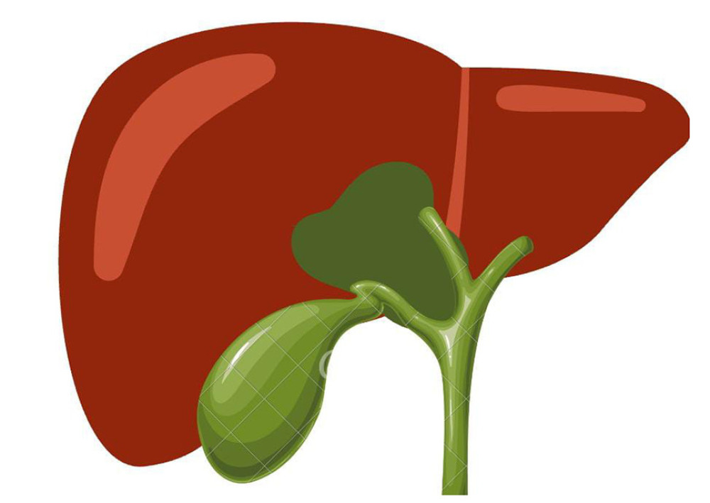 Illustration showing the location of the cyst that originated intrahepatic and extended infrahepatic between the right bile duct and the left bile duct.