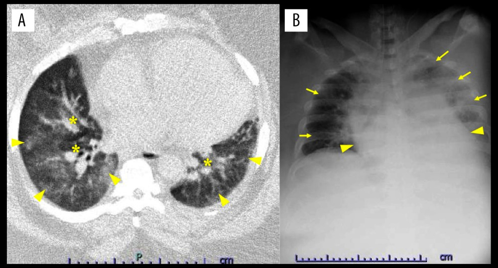 Chest computed tomography (A) and chest X-ray (B) upon admission. (A) Chest computed tomography demonstrating enhanced pulmonary vascular markings (asterisk) and infiltration shadows (triangle arrow) in the bilateral lung fields. (B) Chest X-ray taken immediately after endotracheal intubation, showing cardiomegaly (triangle arrow) and bilateral infiltrates (arrow).