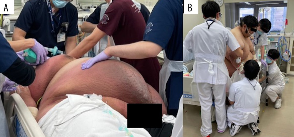 Patient’s photos on ICU admission and on the18th day. (A) Patient with a body weight of at least 250 kg on ICU admission. (B) Encouraging the patient to get out of bed 3 days after extubation. ICU – Intensive Care Unit.