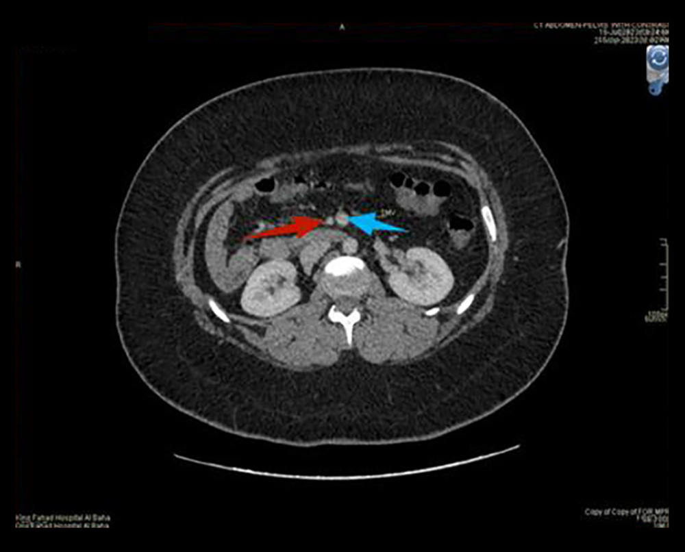 The axial section shows inverted relation between the SMA (red arrow) and the SMV (blue arrow).