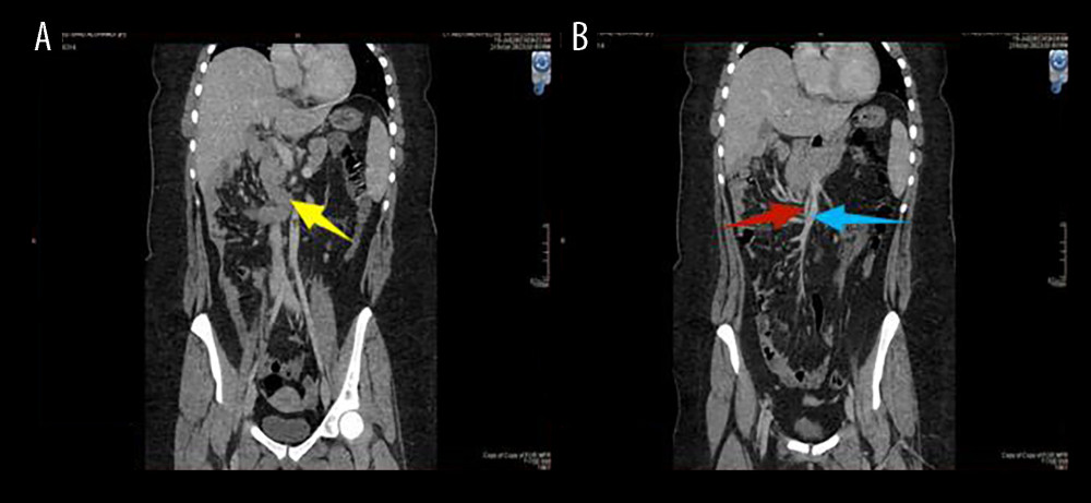 The coronal sections A and B shows DJ junction (yellow arrow) remains at the right side of the abdomen and fails to cross to the left side, and there is an abnormal relationship between SMA and SMV and the SMA, seen at the right (red arrow) and SMV seen at the left (blue arrow).